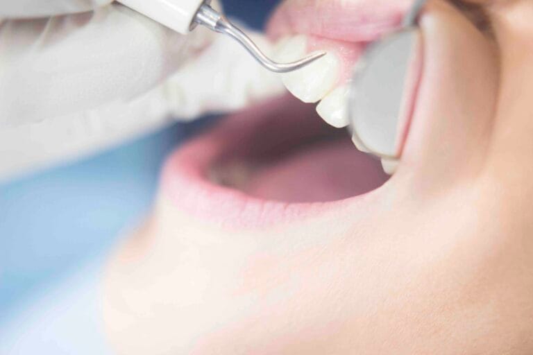 Ogni quanto fare la pulizia dei denti