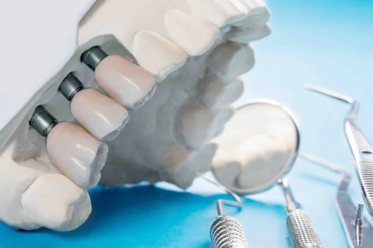 dolore dopo l'impianto dentale dolore dopo l'impianto dentale